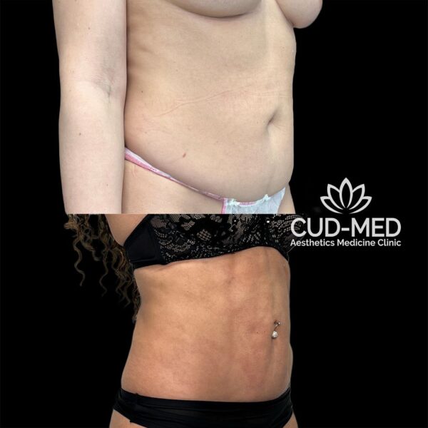 liposukcja ciało (1) liposukcja ciało (1)