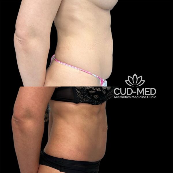 liposukcja ciało (2) liposukcja ciało (2)