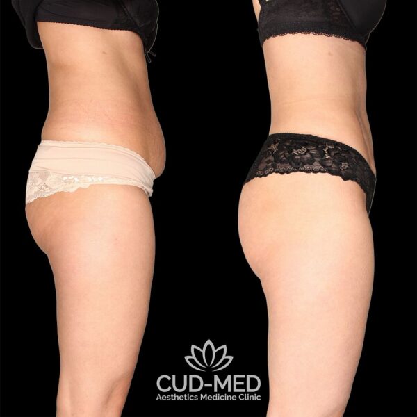 liposukcja ciało (3) liposukcja ciało (3)