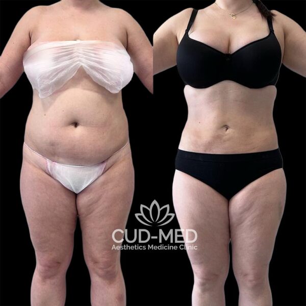 liposukcja ciało (4) liposukcja ciało (4)
